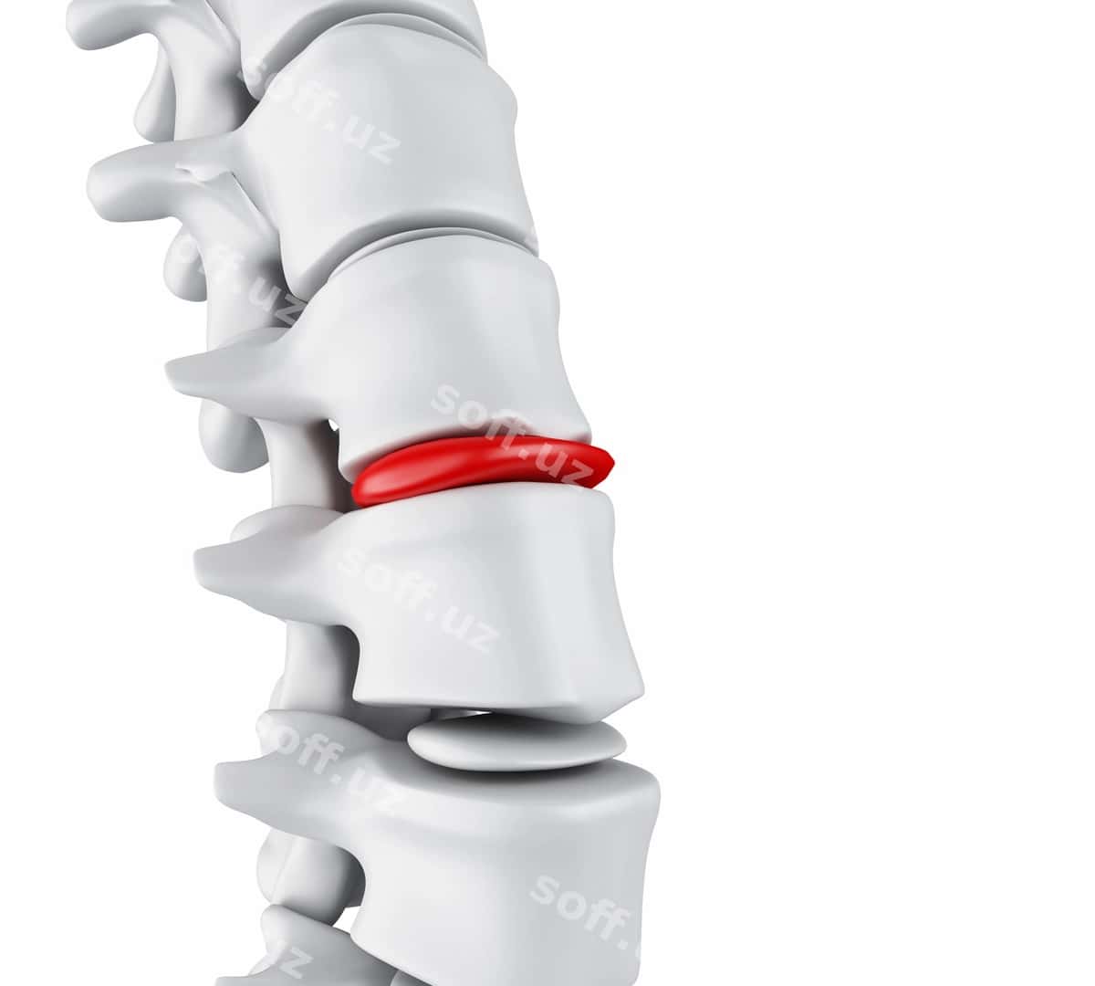 3D churrali disk tushunchasi | 3d herniated disk concept 1