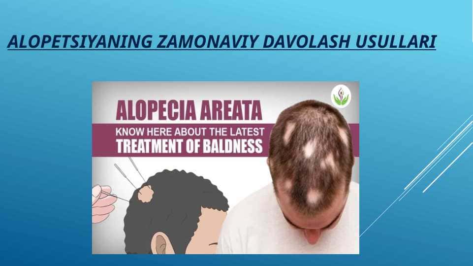 ALOPETSIYANING ZAMONAVIY DAVOLASH USULLARI
