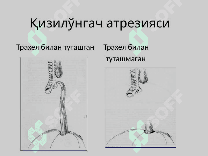 Bolalarda qizilo'ngach tug'ma nuqsonlari . Qizilo'ngachning tug'ma nuqsonlari . Болаларда кизилунгачнинг тугма нуксонлари. Диагностика ва дифференциал диагностикаси  Врач педиатр тактикаси. 5