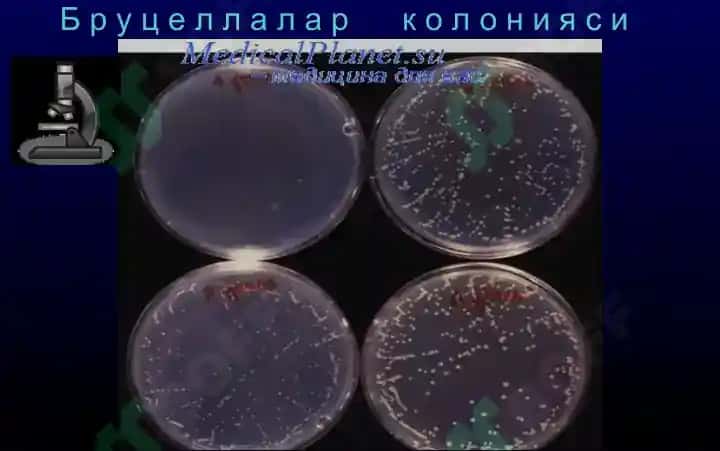 Бруцеллёз - Мальта иситмаси 8