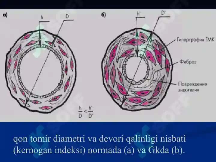 GIPERTONIYA KASALLIGI 8