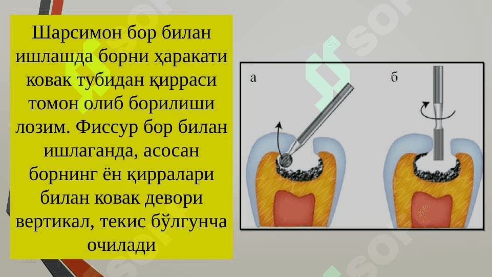 Tish qattiq to'qimalarini charxlash
      bosqichlari va tamoyillari 5