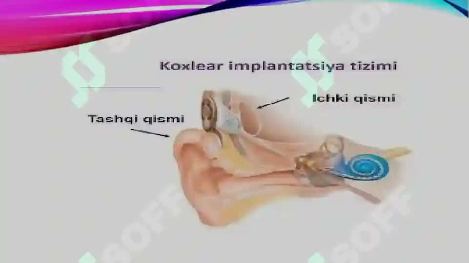 Koxlear implantli bolalarning eshituv-nutqiy reabilitatsiyasi bosqichlari tavsifi 8