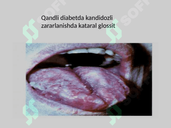 Ichki a'zolar kasalliklarini og'iz bo'shlig'i shilliq qavatida terida  lab qizil hoshiyasida namoyon bo'lishi 7
