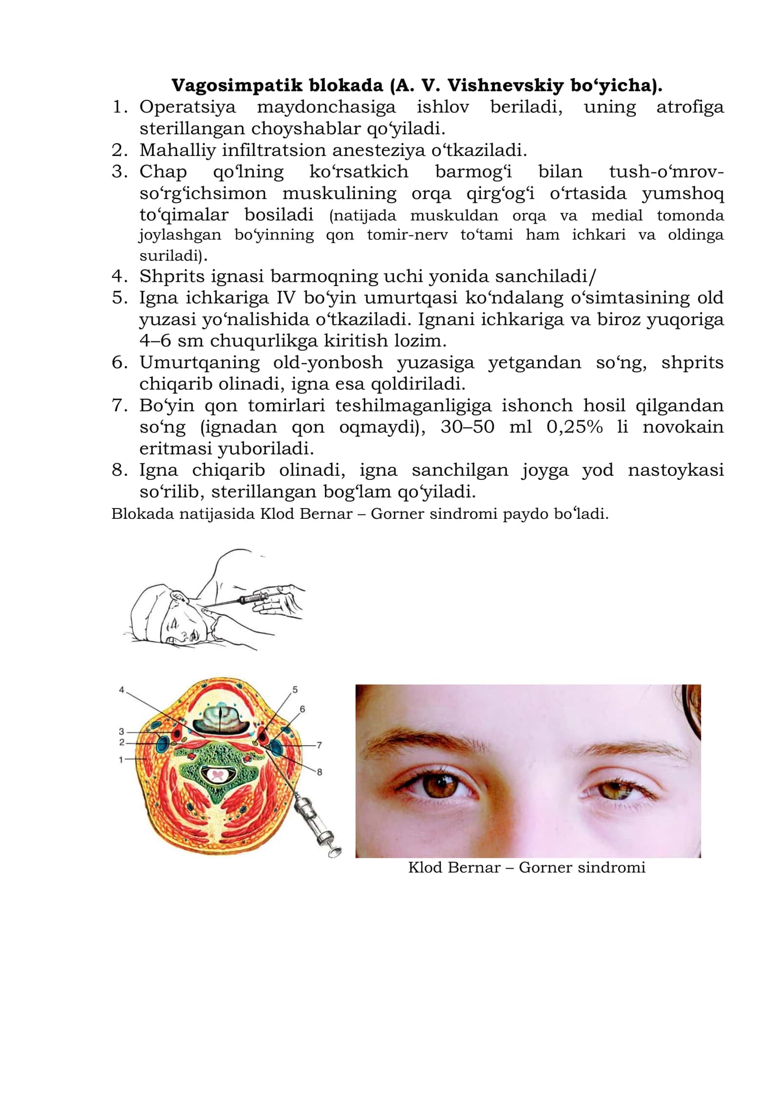 Vagosimpatik blokada (A. V. Vishnevskiy bo‘yicha) 1