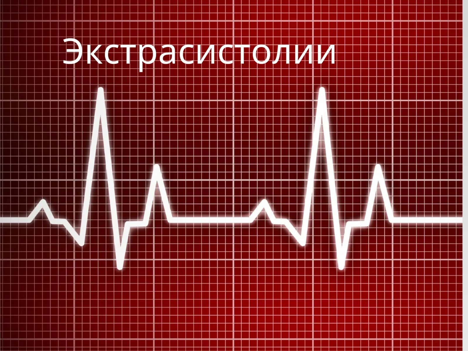 Экстрасистолии 1