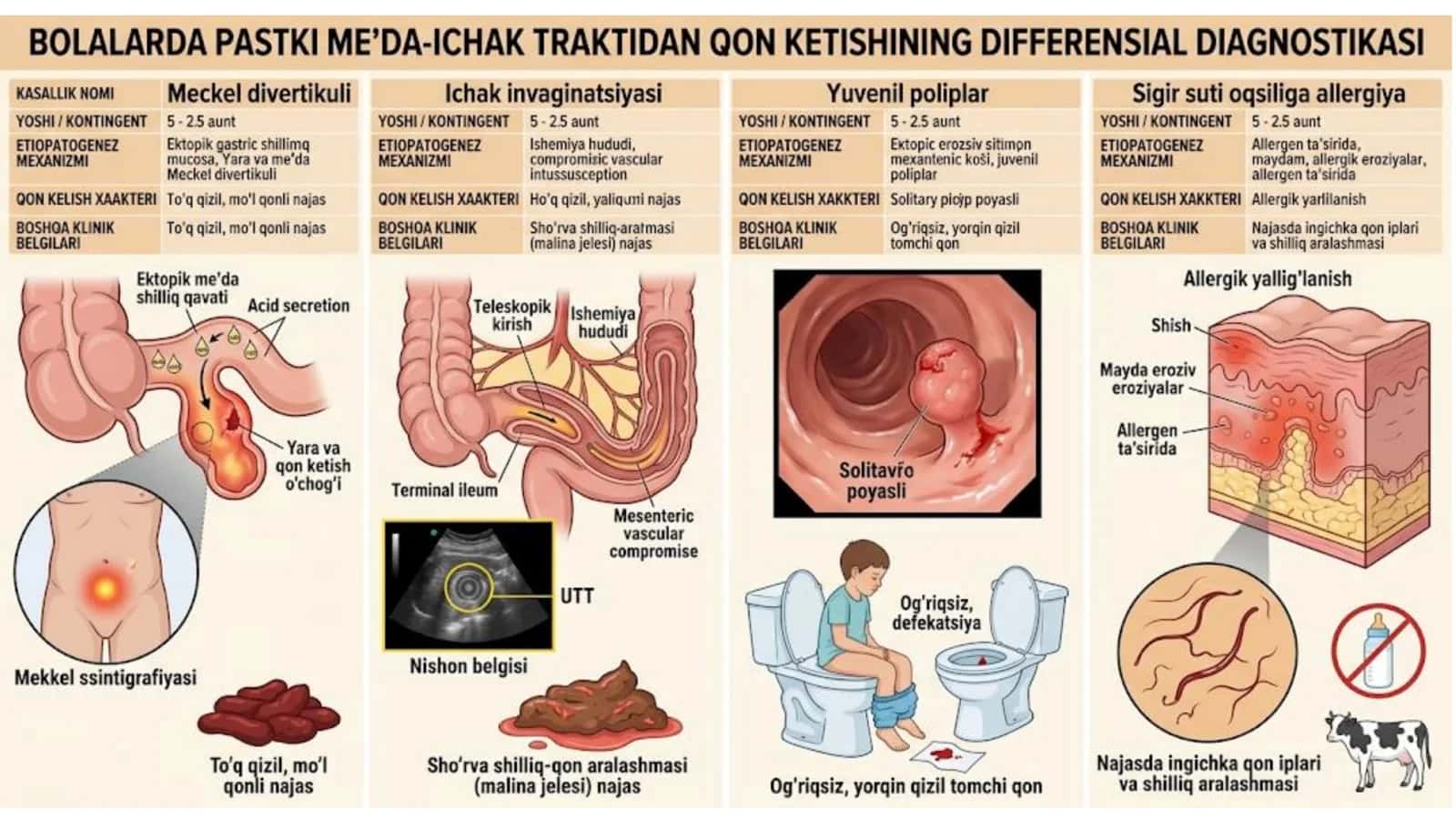 Ichaklardan qon ketish: Mekkel divertikuli (Meckel's Diverticulum) 2