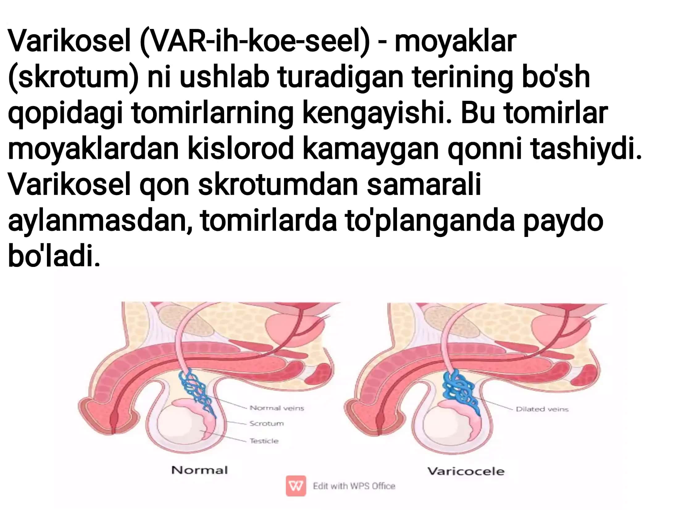 Varikosel (VAR-ih-koe-seel) - moyaklar 2