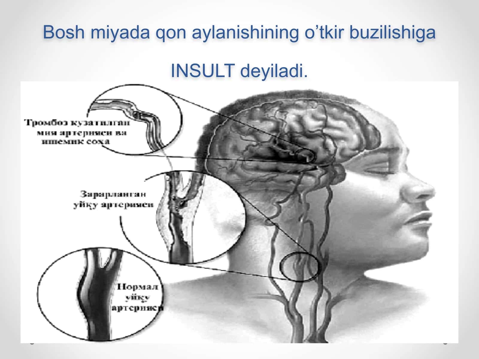 Ishemik insult 2