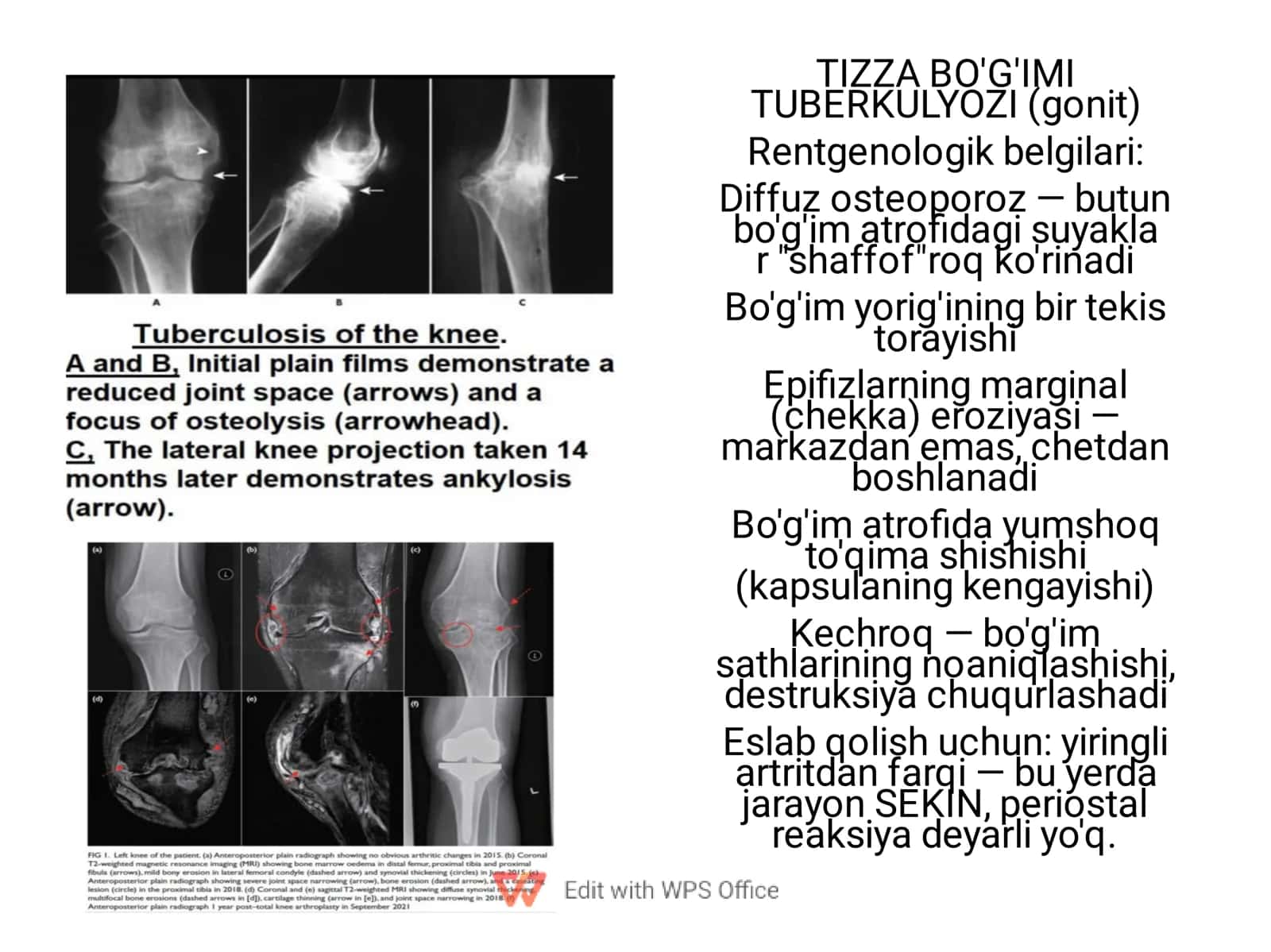 UMURTQA TUBERKULYOZI (Pott kasalligi / spondilit) 2