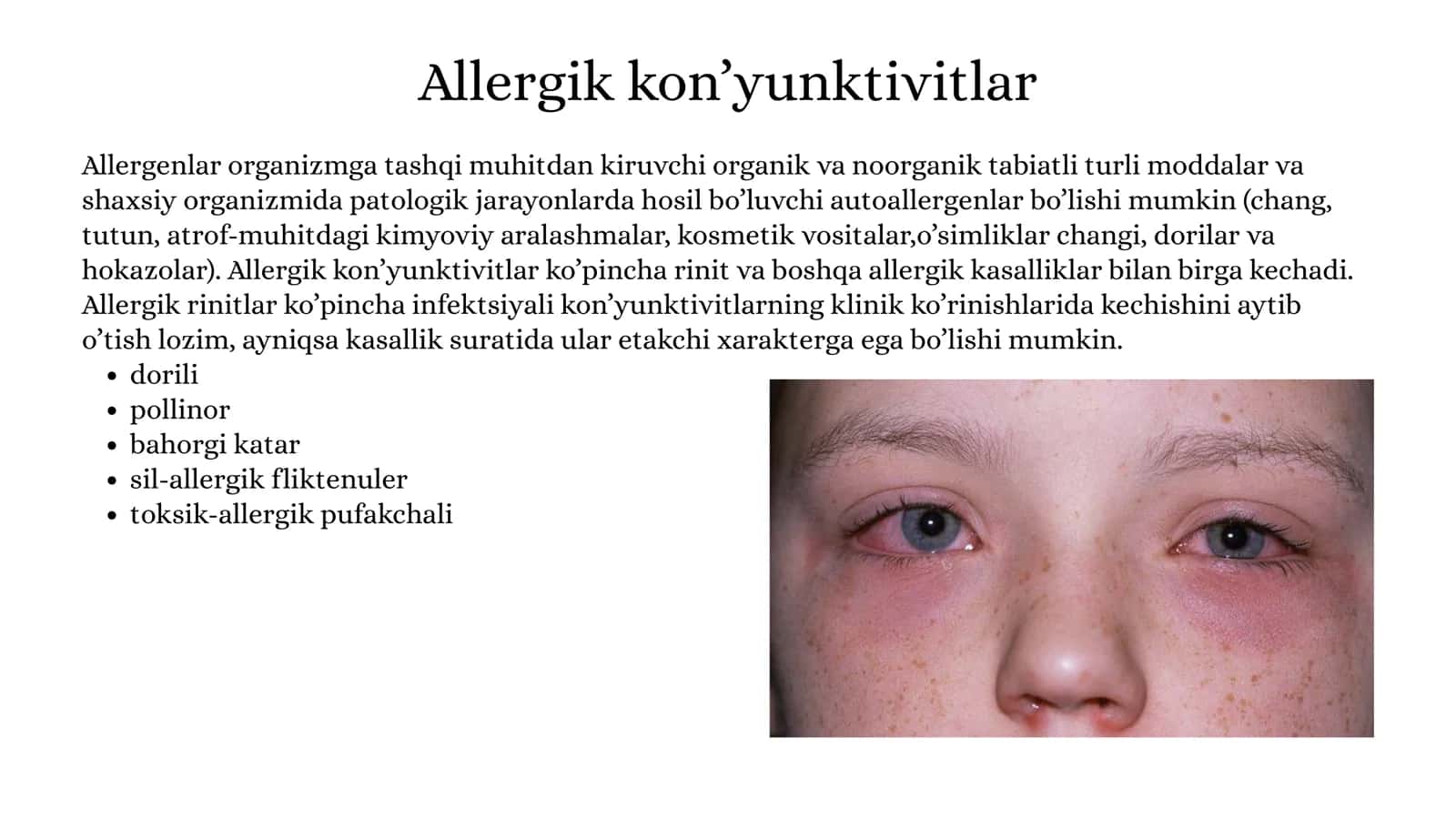 Allergik kon’yunktivitlar 2