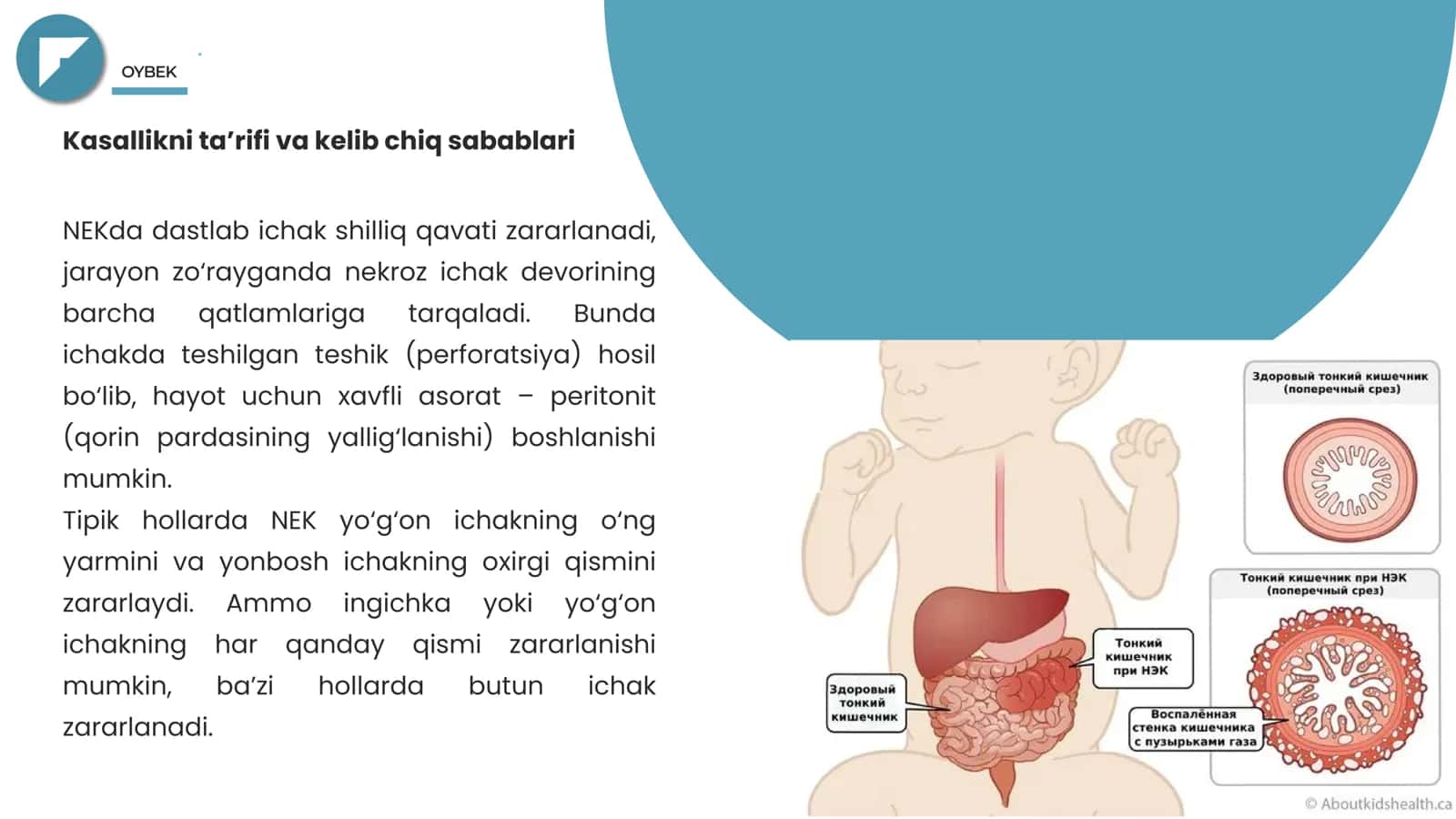 Chaqaloqlarda Nekrotik Enterokolit 3
