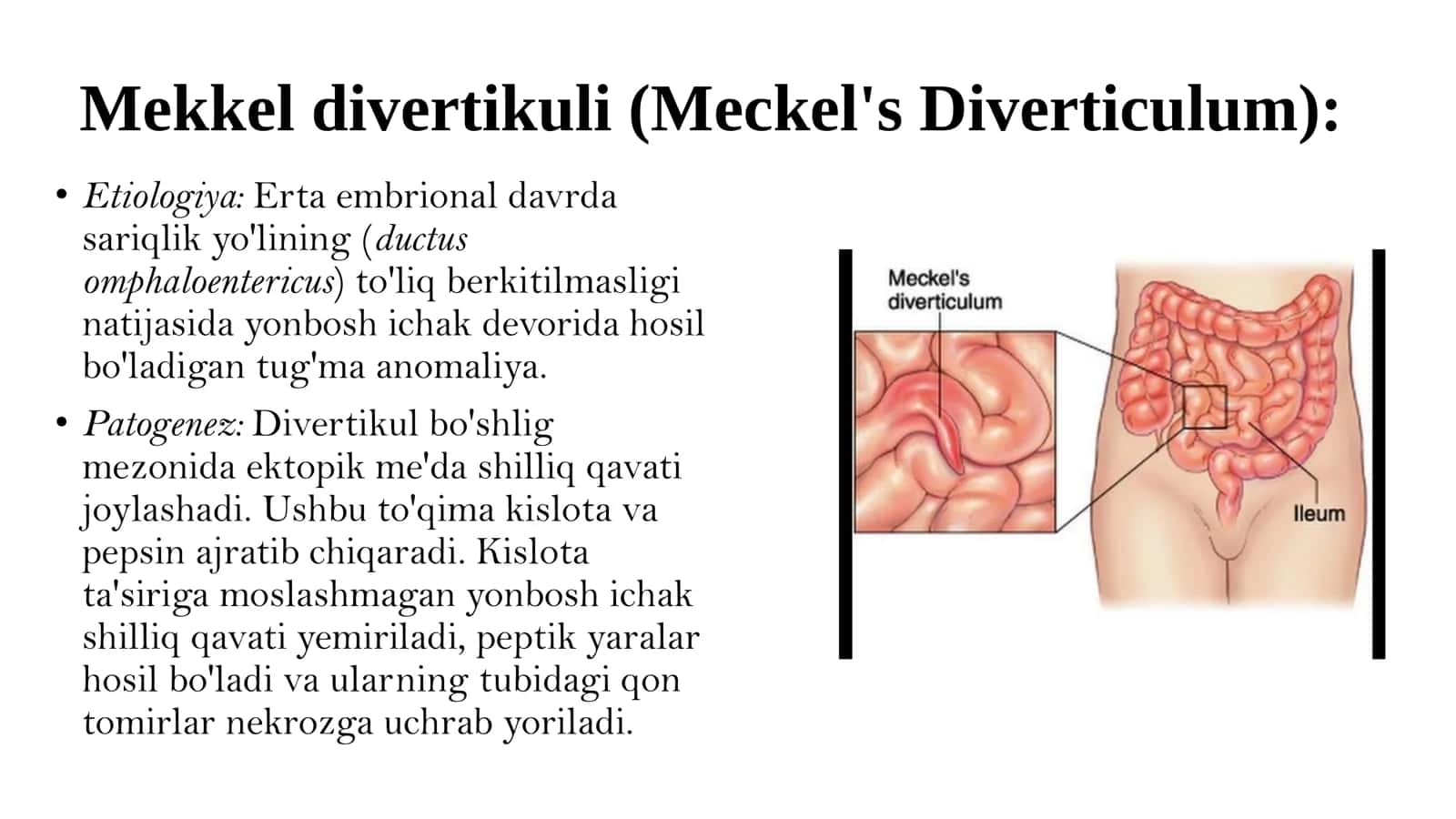 Ichaklardan qon ketish: Mekkel divertikuli (Meckel's Diverticulum) 3