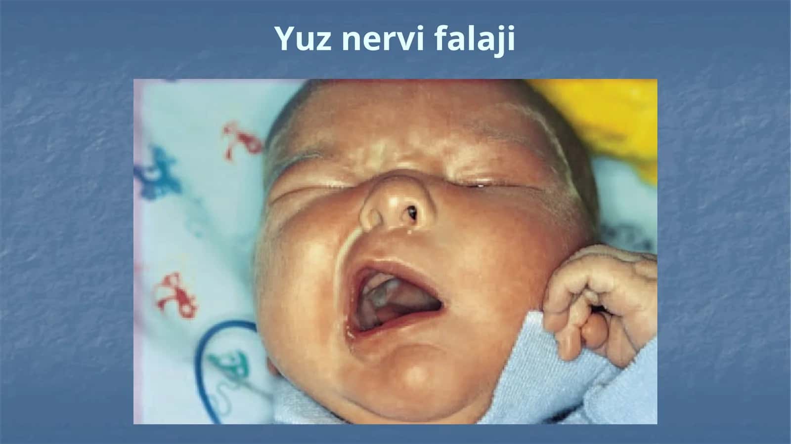 Yuz nervi falaji 1