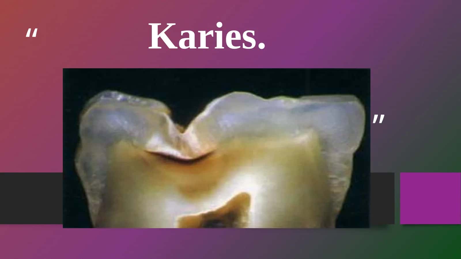Karies 1