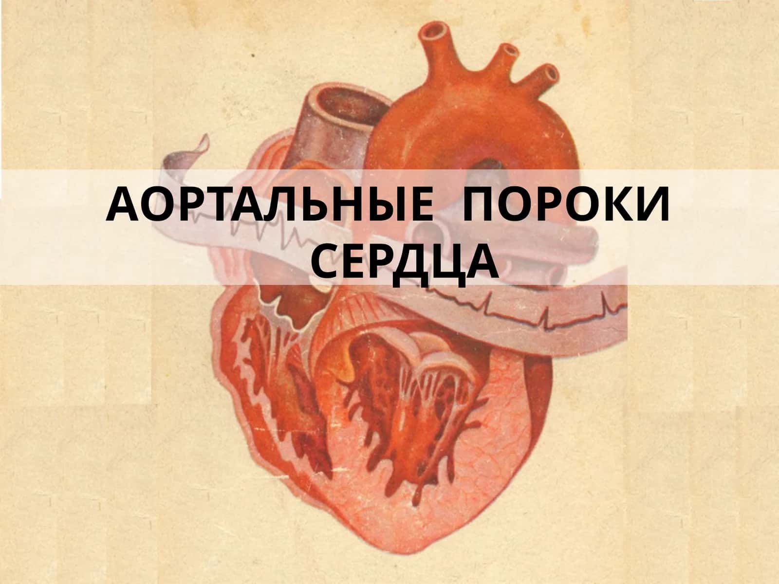 Недостаточность аортального клапана 1