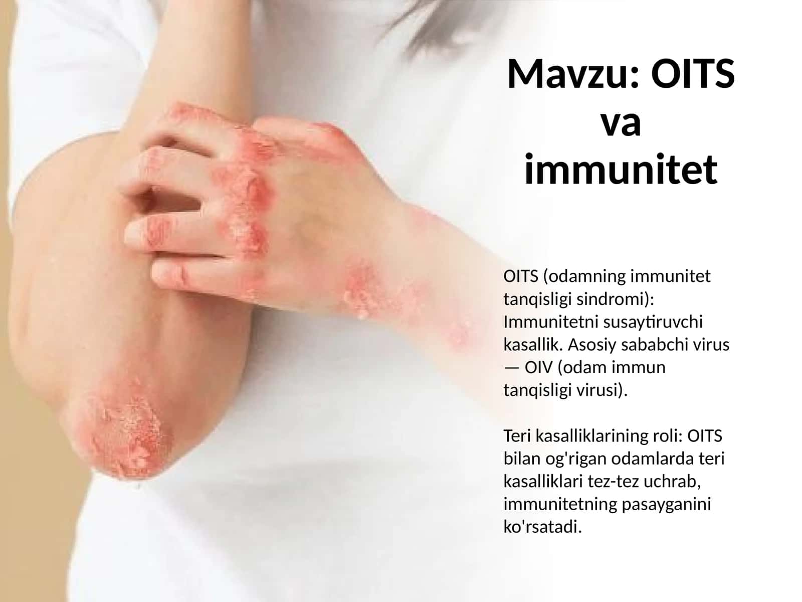 OITS va immunitet 1