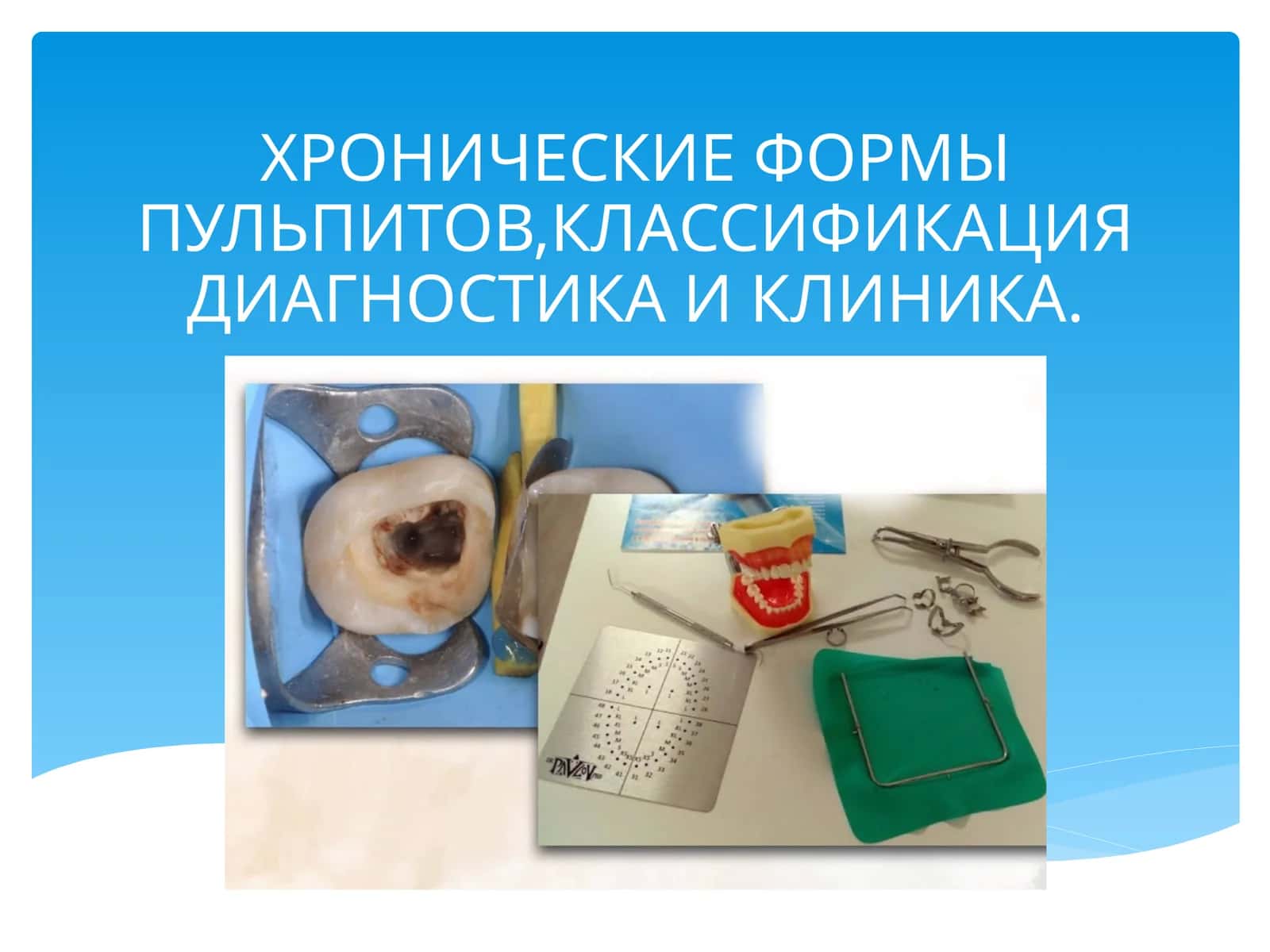 ХРОНИЧЕСКИЕ ФОРМЫ ПУЛЬПИТОВ,КЛАССИФИКАЦИЯ ДИАГНОСТИКА И КЛИНИКА 1