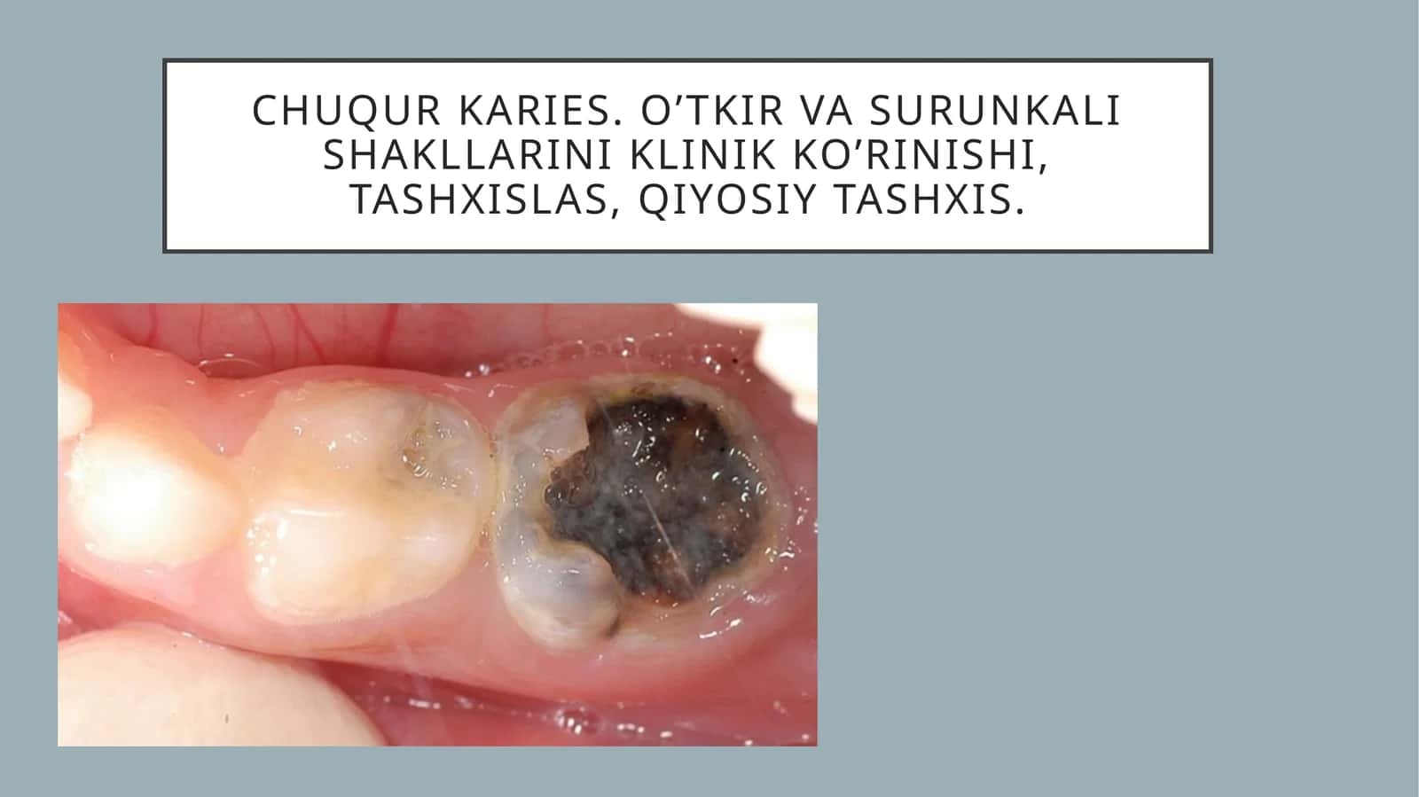 Chuqur karies 1