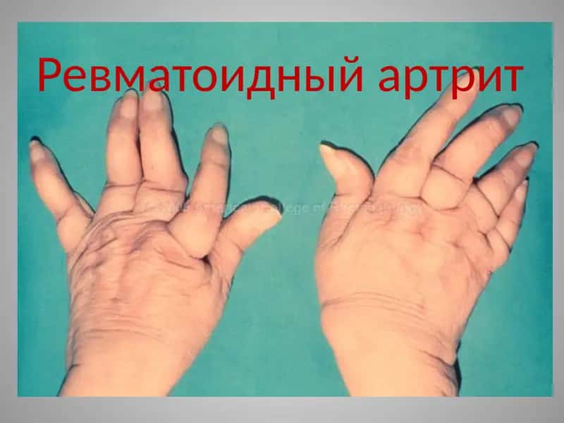 Ревматоидный артрит 1