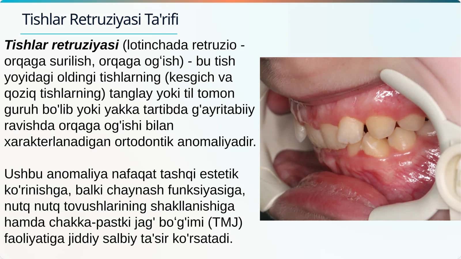 Tishlar retruziyasi 1