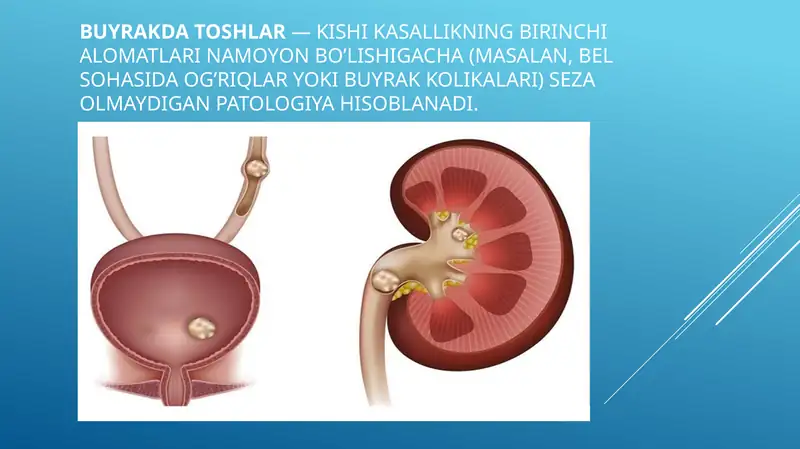 Siydik tosh kasalligi 1