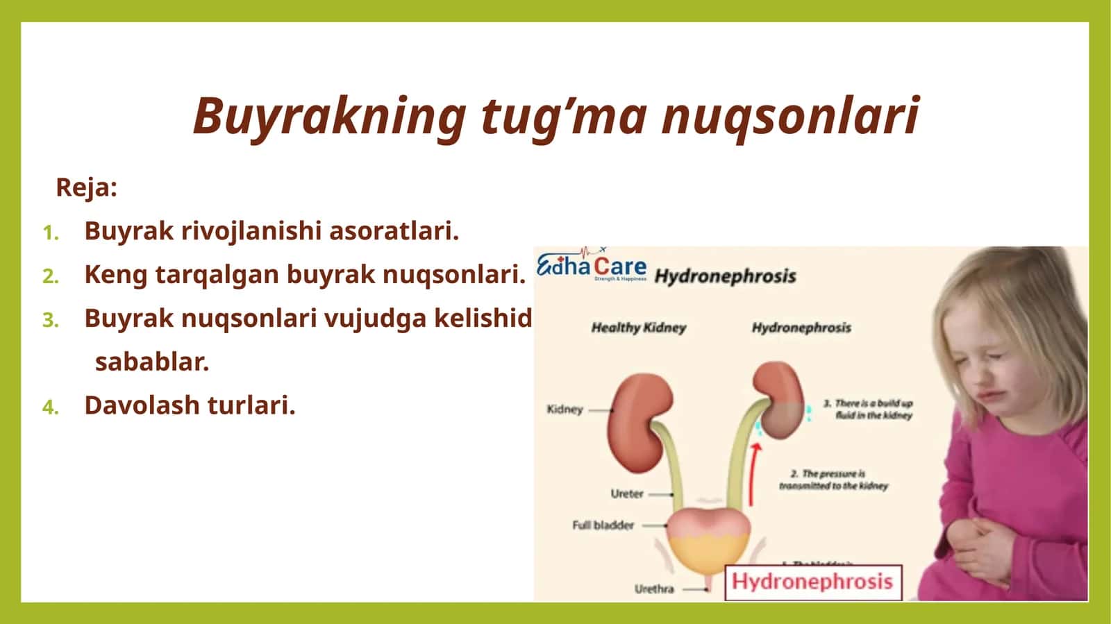 Buyrakning tug’ma nuqsonlari 1