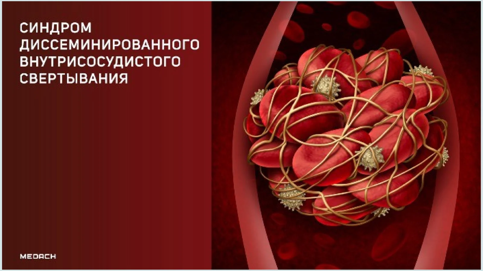 DVS sindromi 1
