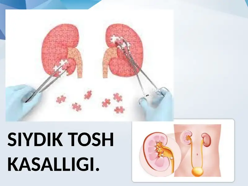 Siydik tosh kasalligi. 1