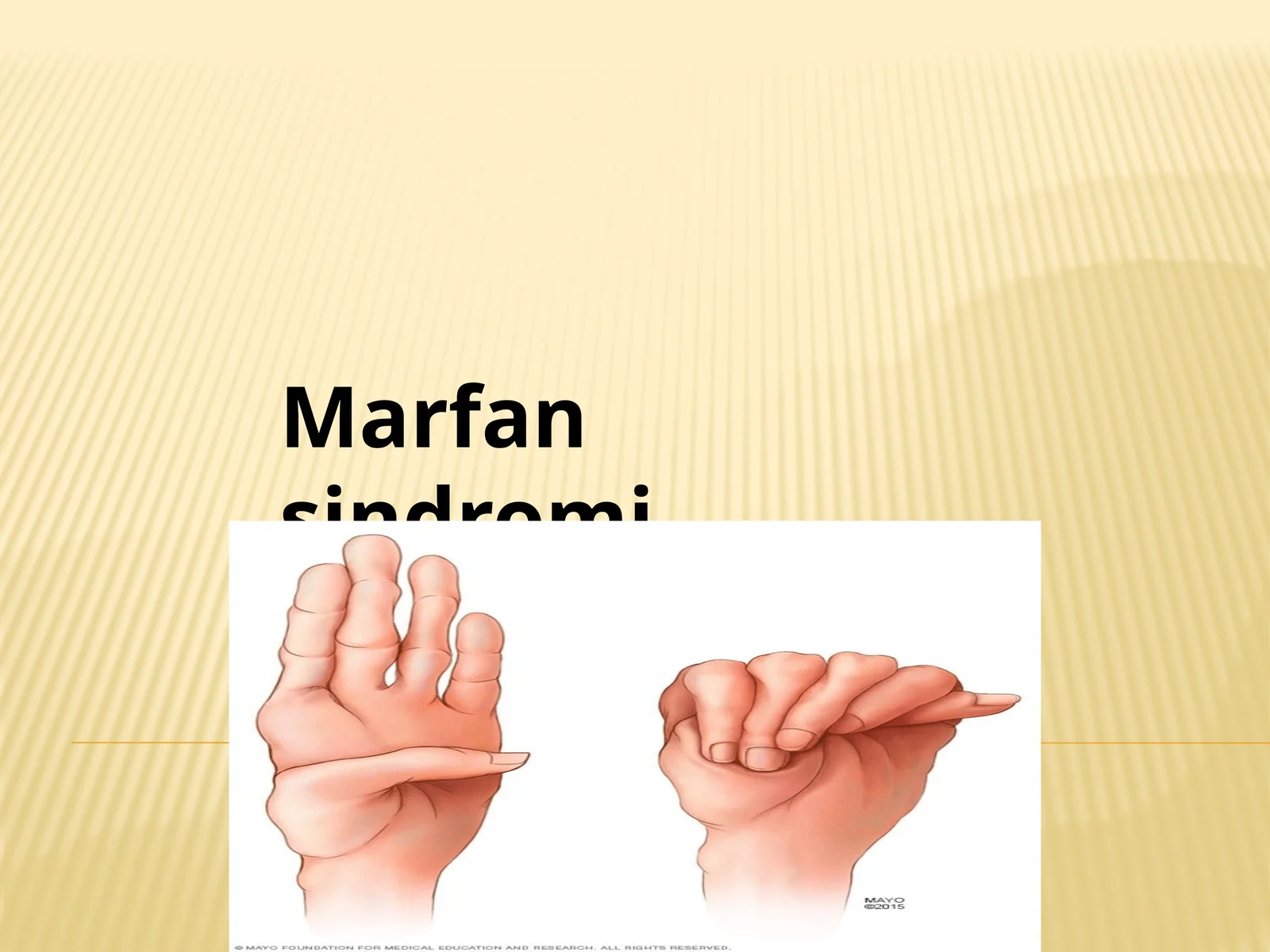 Marfan sindromi 1