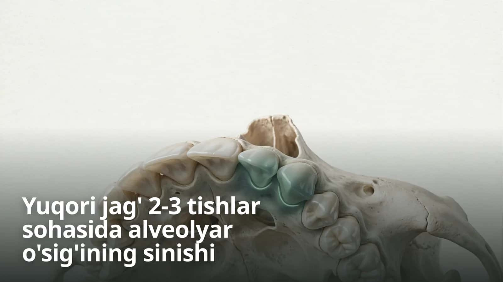 Yuqori jag’ 2-3tishlar sohasida alveolyar o’sig’ining sinishi 1