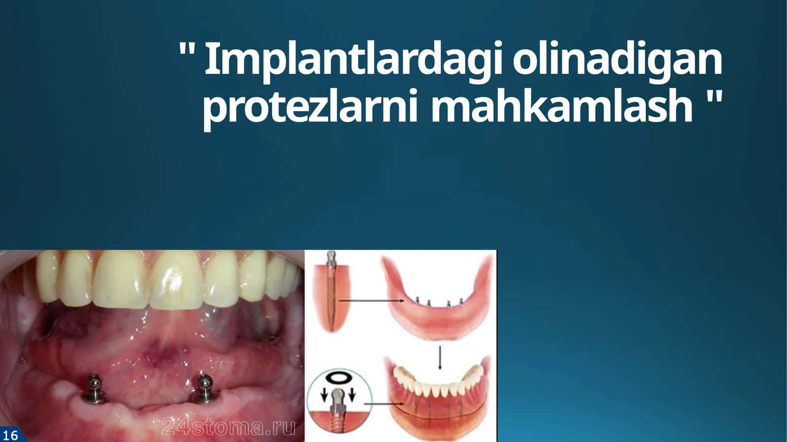 To'liq olib qo'yiladigan protezlarni implantlar bilan fiksatsiya qilish turlari 1