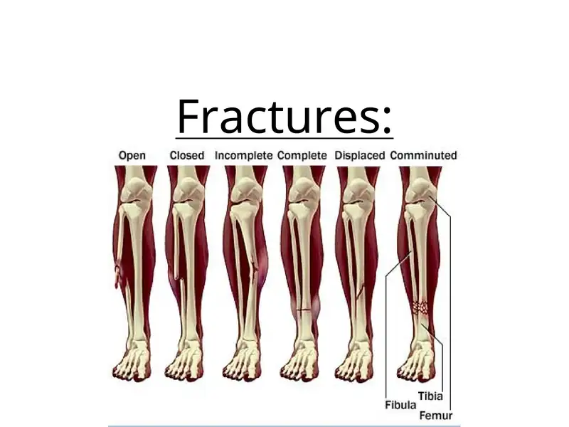 Fractures 1