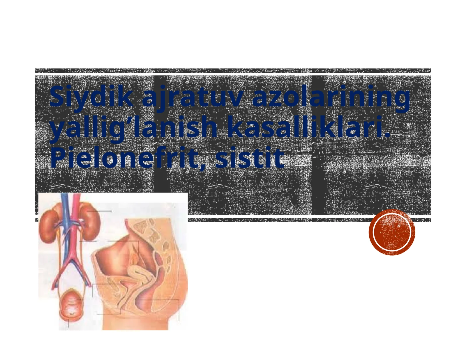 Siydik yo’llari yallig’lanish kasalliklari. Pielonefrit, sistit 1