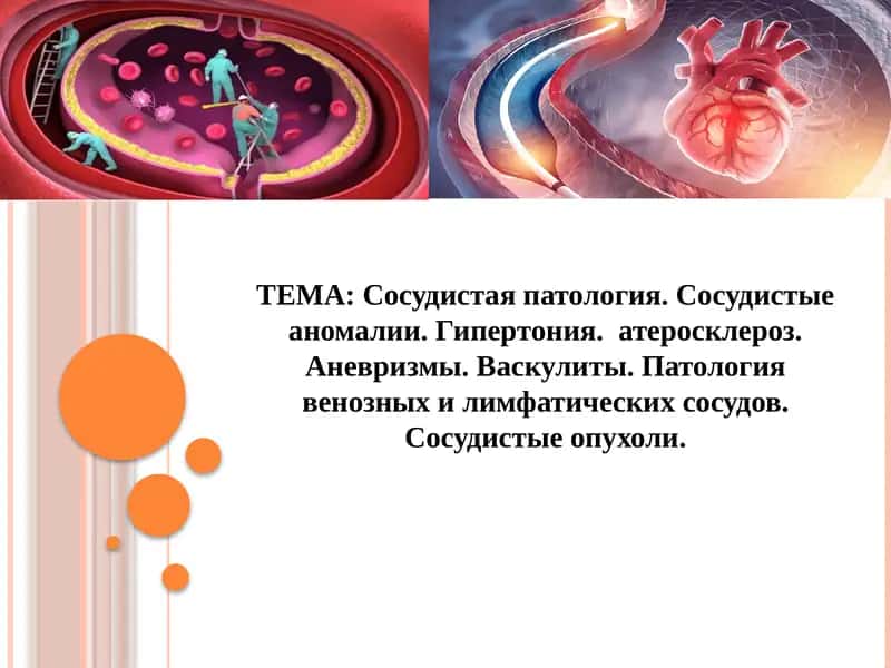 Сосудистая патология. Сосудистые аномалии. Гипертония.  атеросклероз. Аневризмы. Васкулиты. Патология венозных и лимфатических сосудов. Сосудистые опухоли. 1