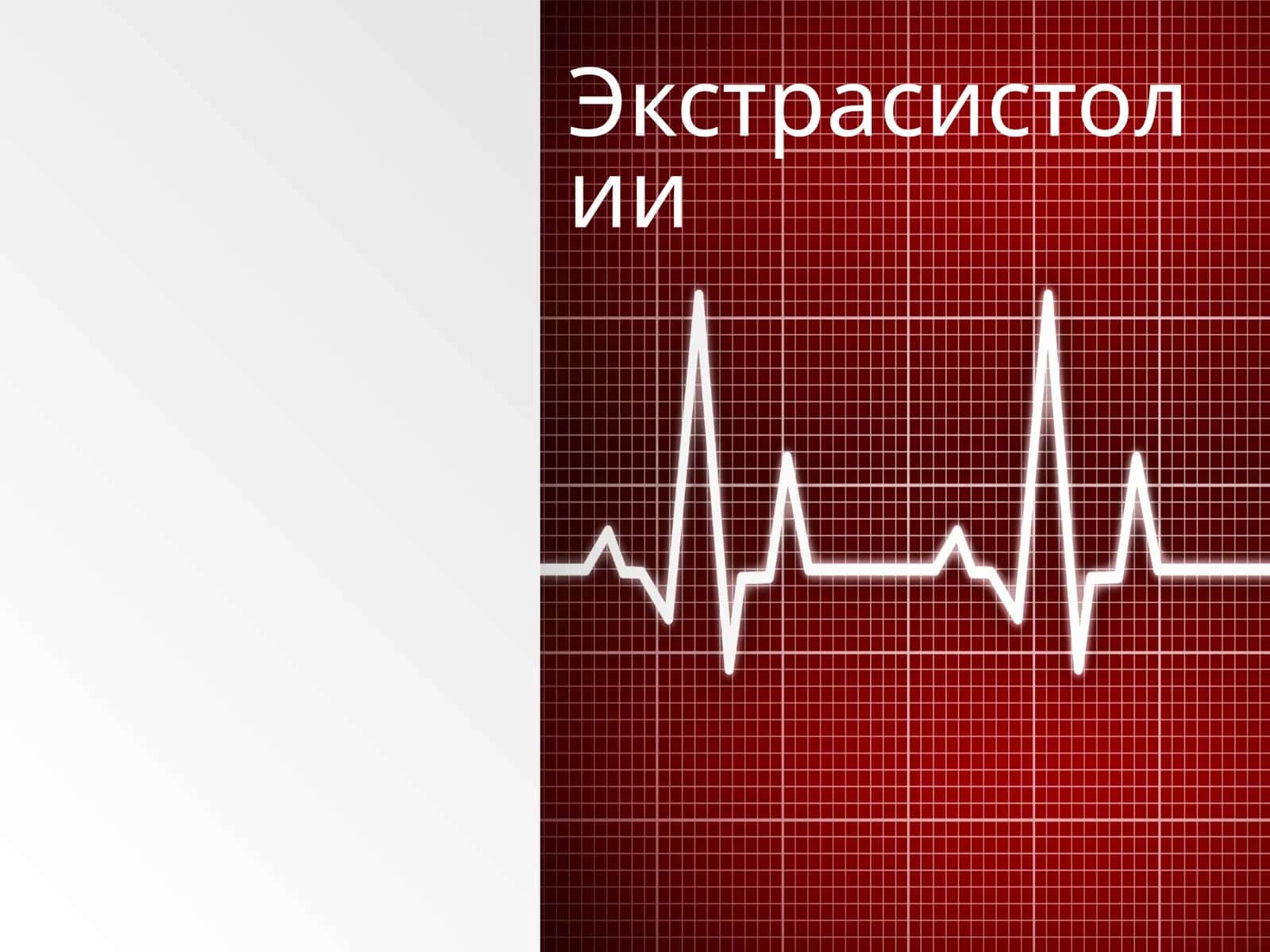 Экстрасистолии 1