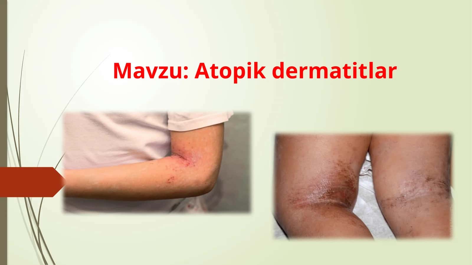 Atopik dermatitlar 1