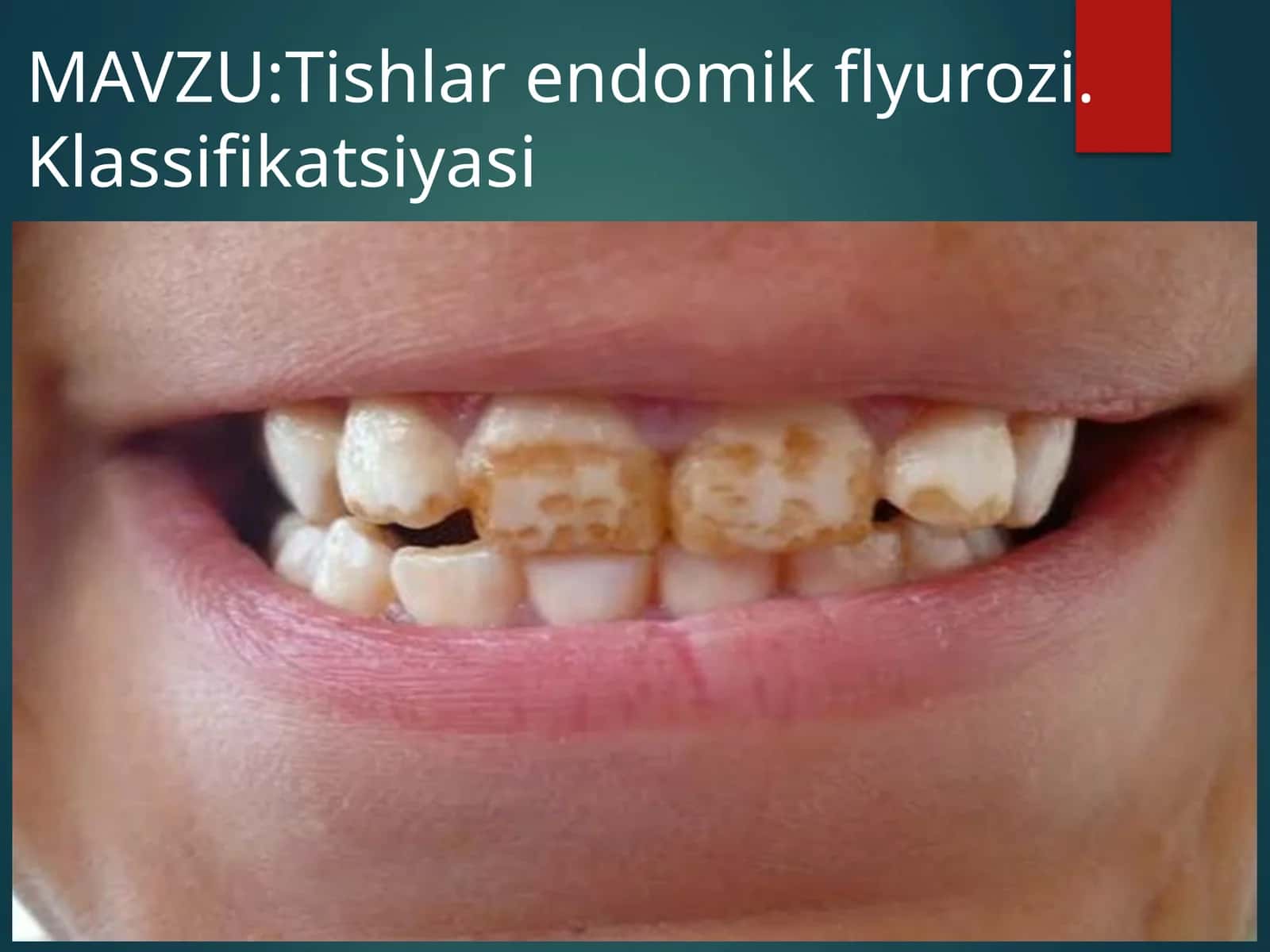 Tishlar endomik flyurozi. Klassifikatsiyasi 1