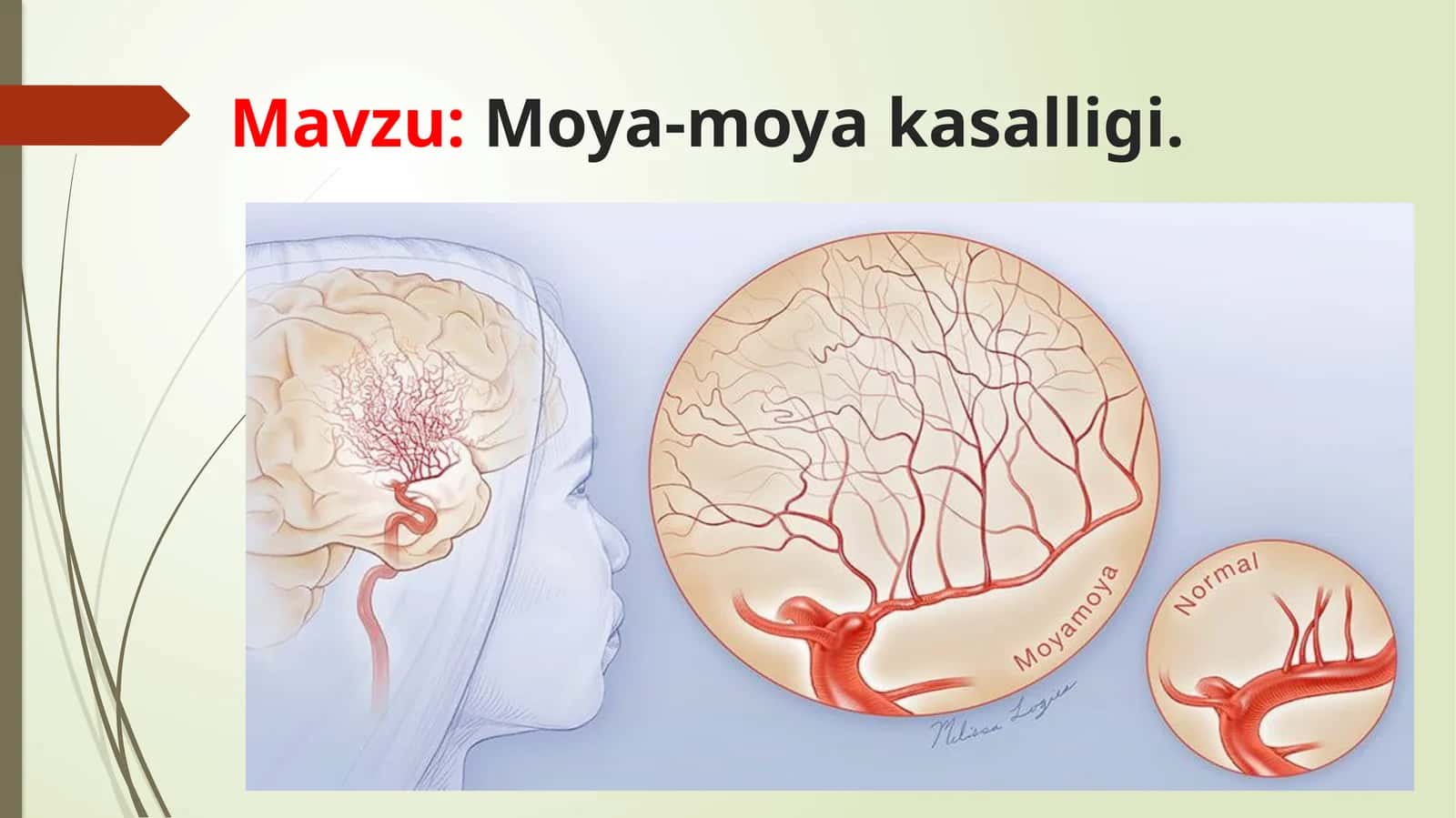 Moya-moyakasalligi 1