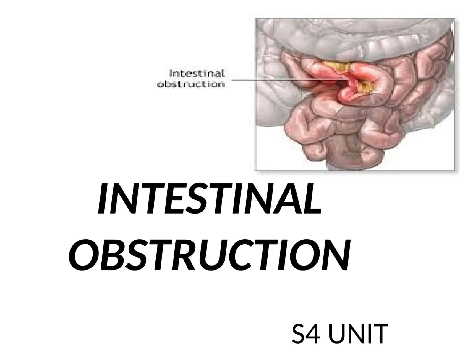 INTESTINAL OBSTRUCTION 1