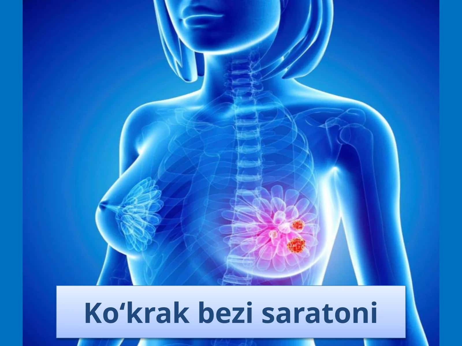 Ko‘krak bezi saratoni 1