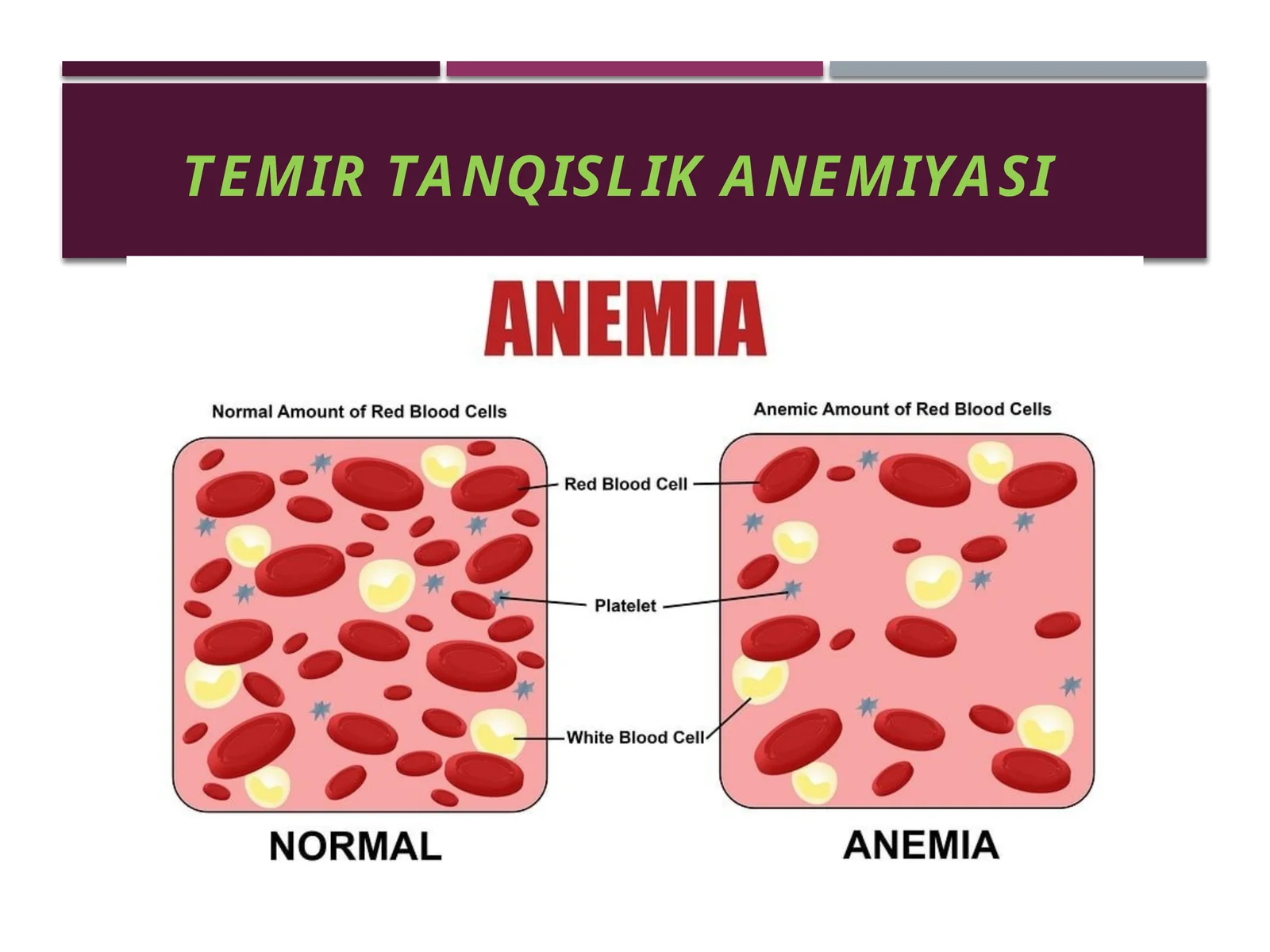 TEMIR TANQISLIK ANEMIYASI 1