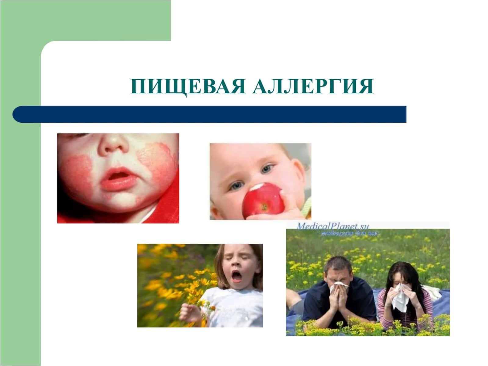 Пищевая аллергия 1