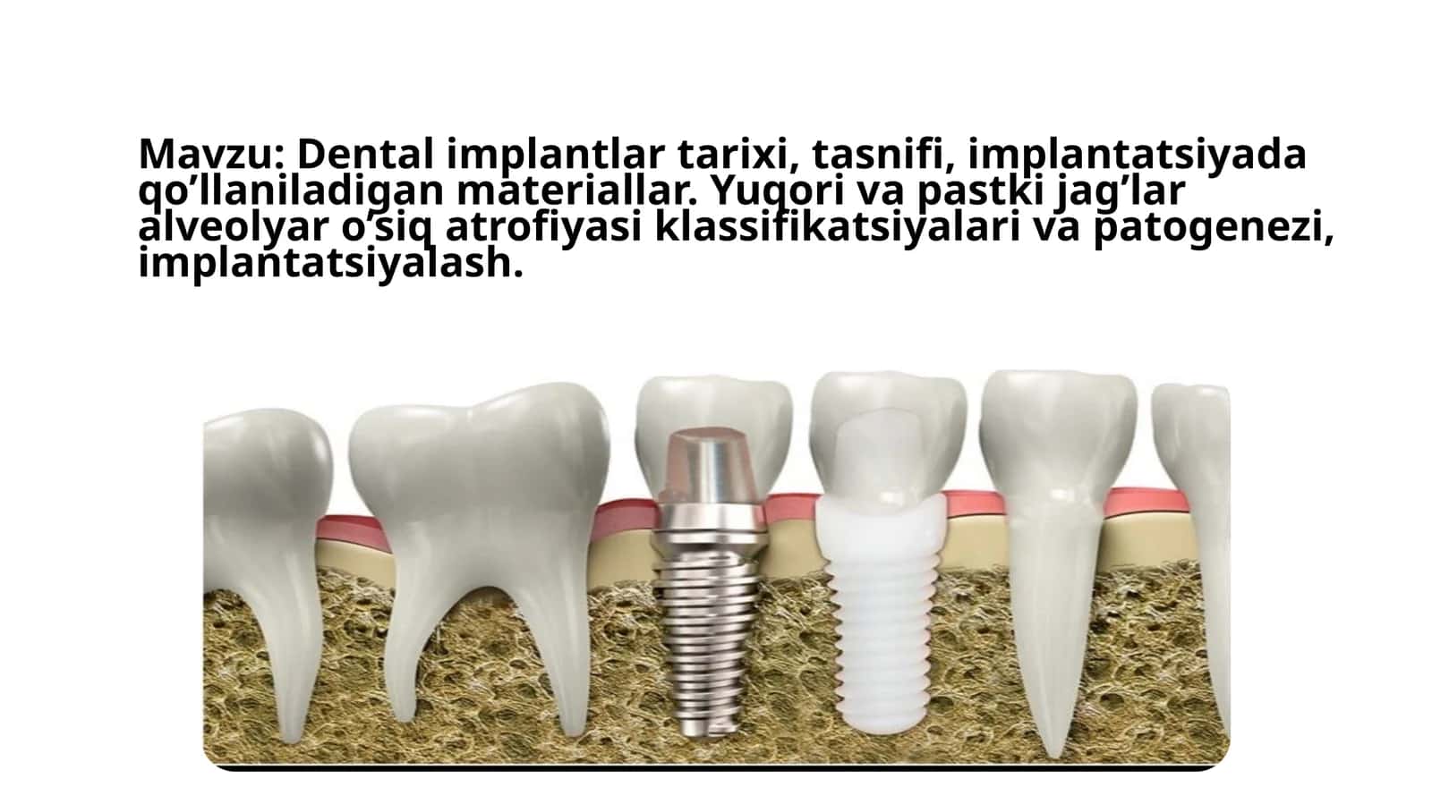 Dentalimplantlar tarixi 1