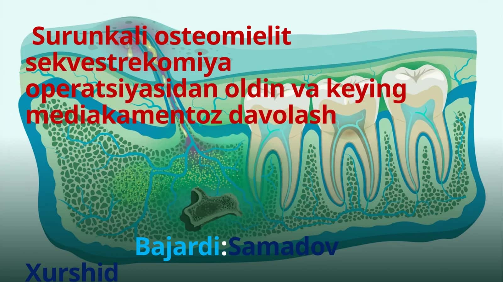 Surunkali Osteomielit Sekvestrekomiya Operatsiyasi 1