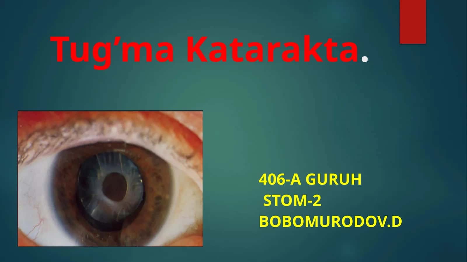 Tug'ma katarakta 1