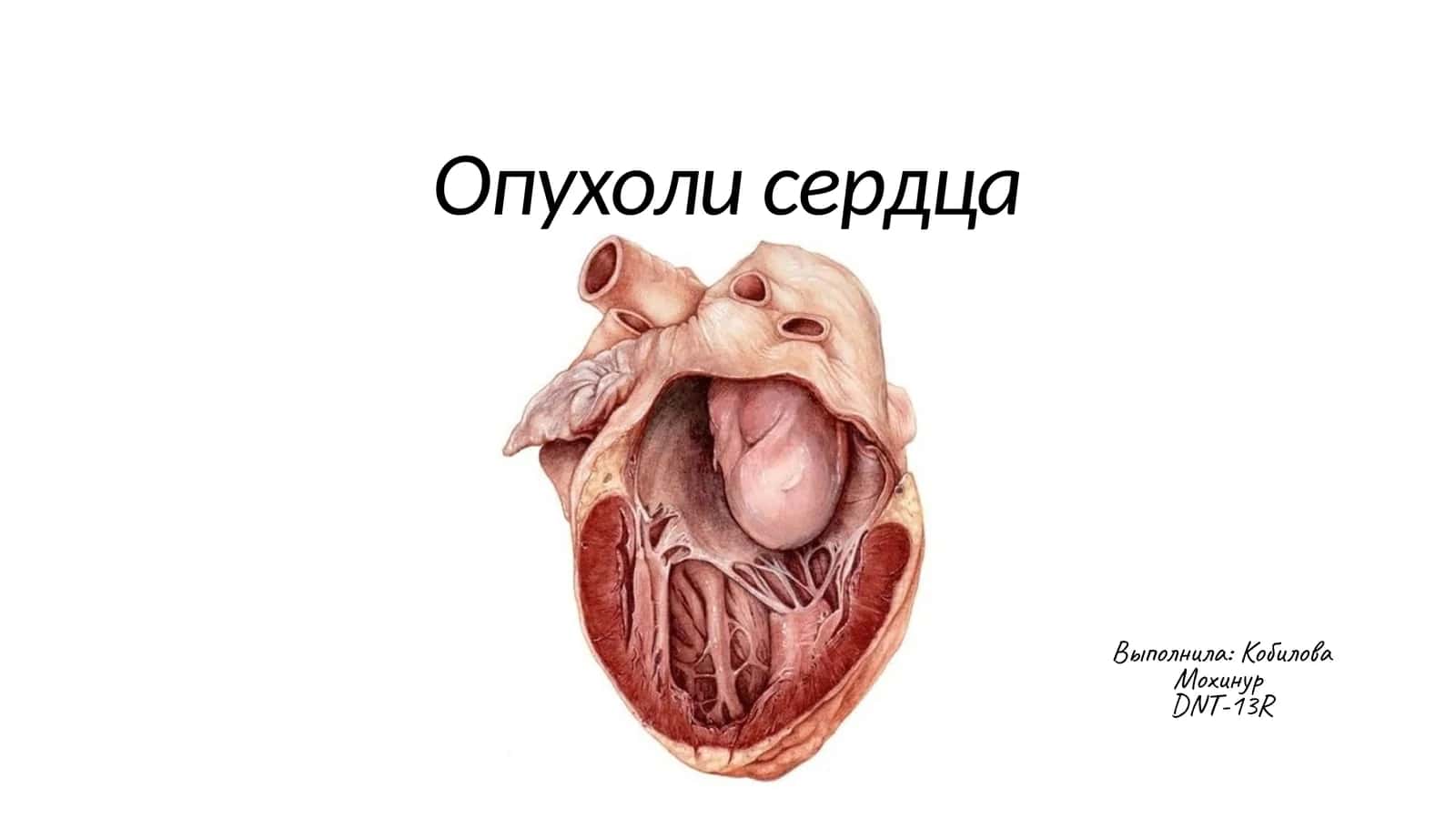 Опухоли сердца 1