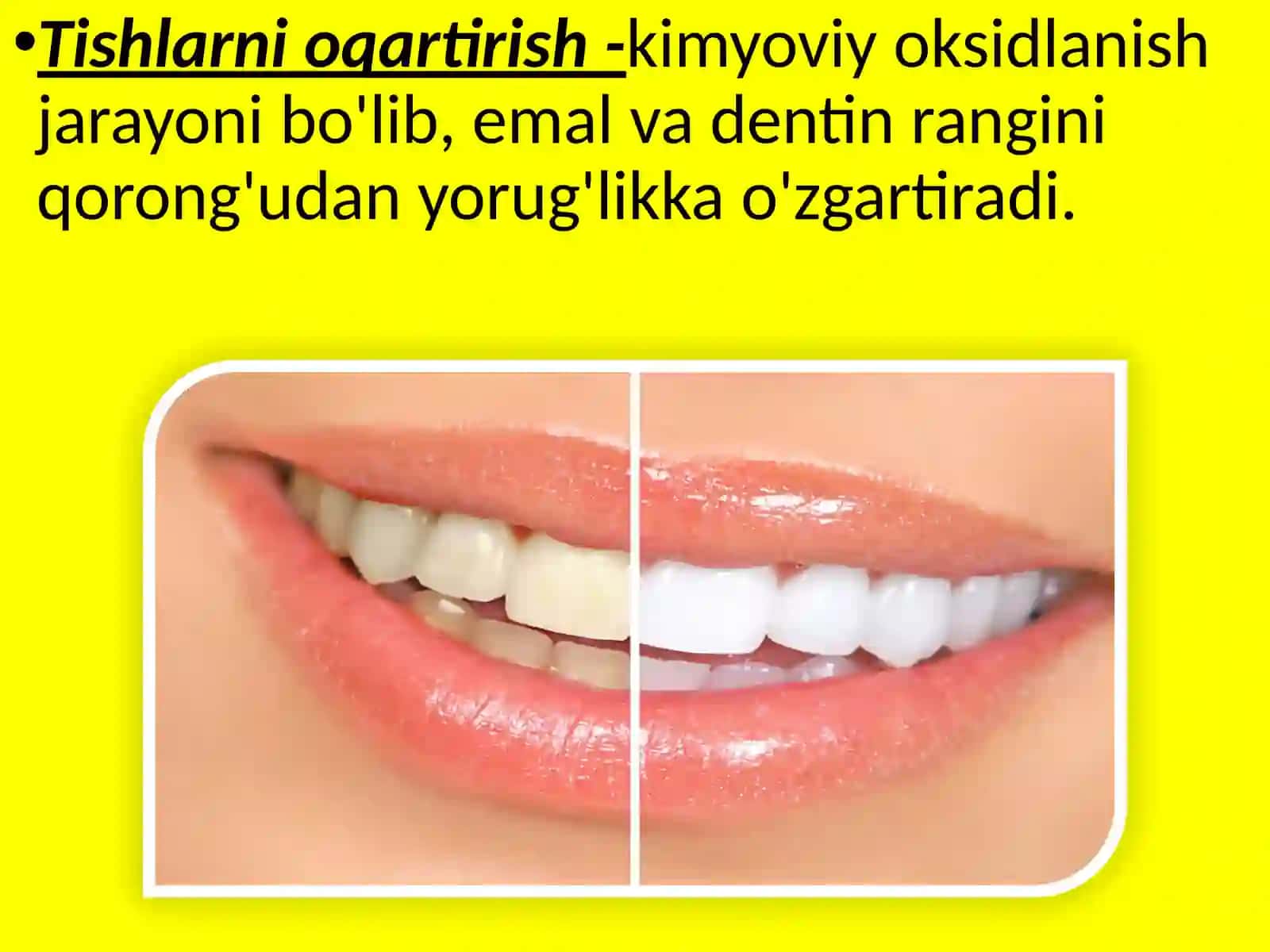 Tishlarni oqartirish usullari 2