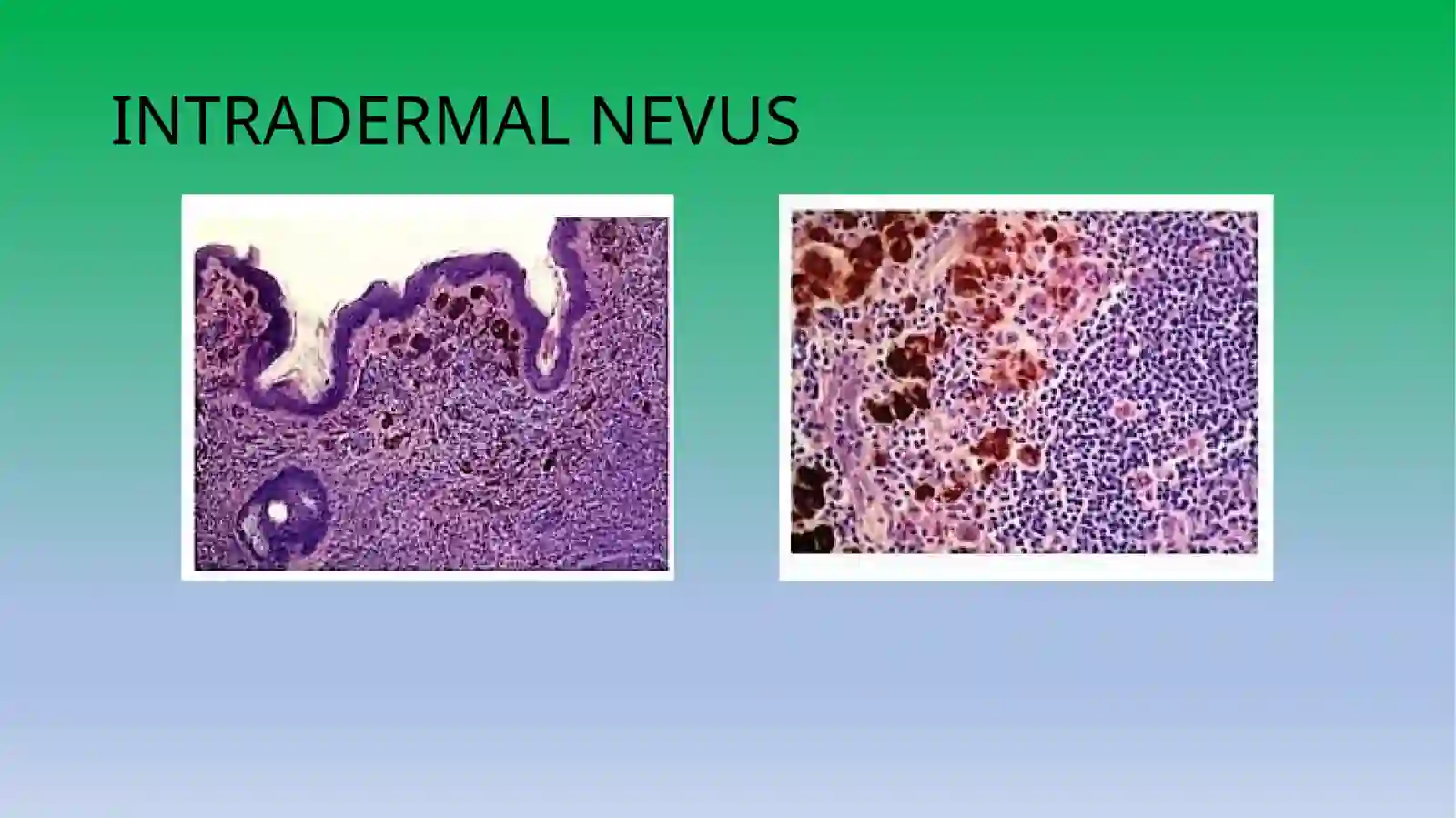 Chegaradagi nevus 2