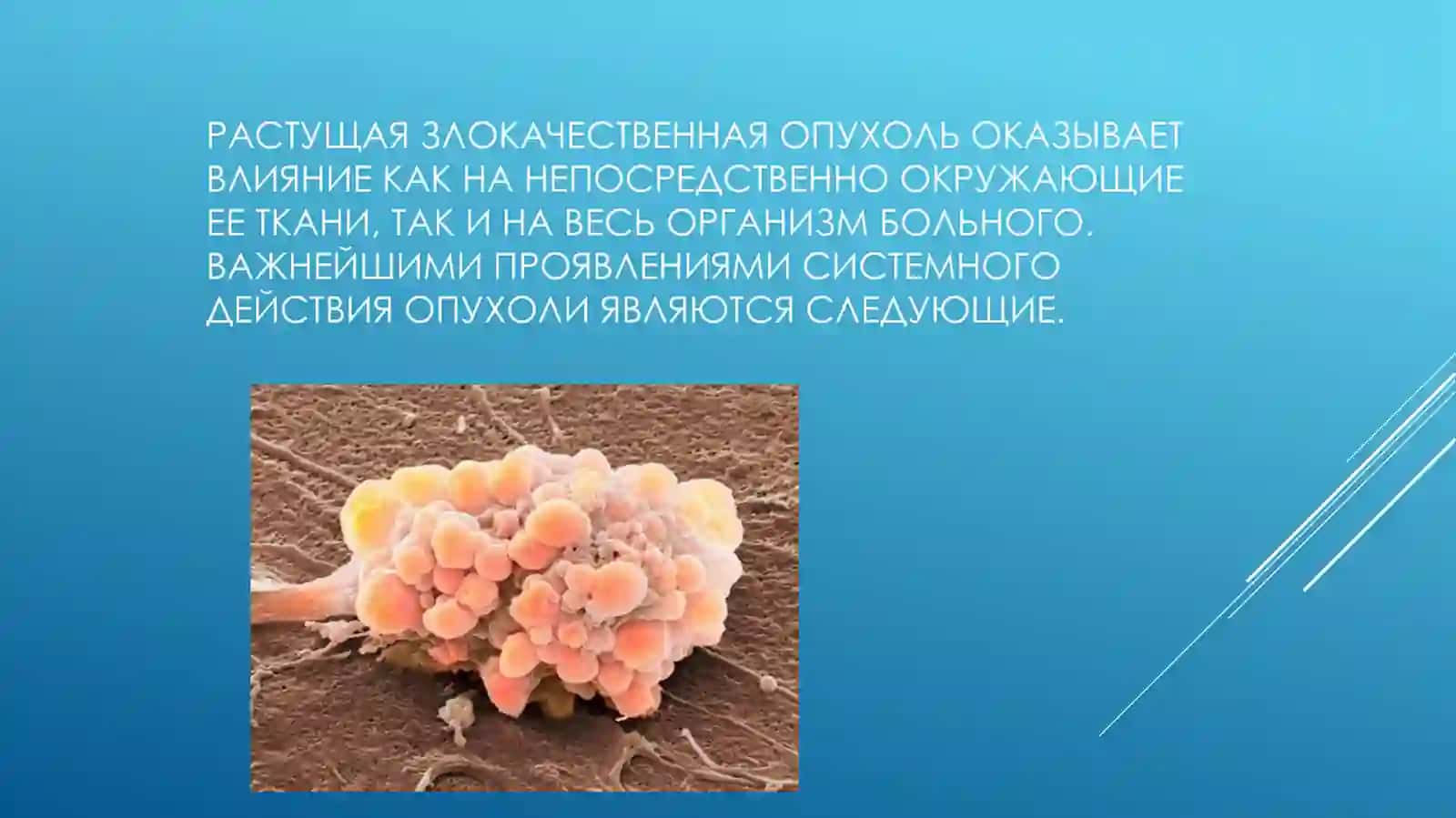 Опухоль 2